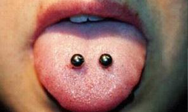 舌钉
