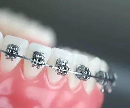 为什么说，牙齿矫正越快越好呢？