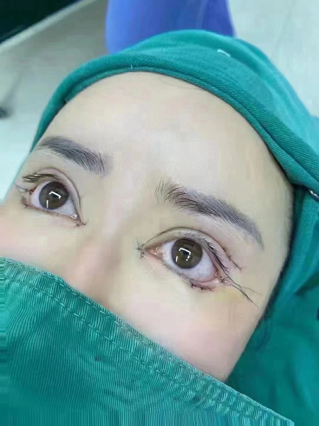 双眼皮手术培训