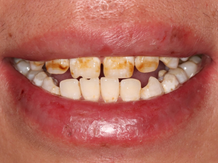 牙齿矫正的价格是由哪些因素决定的?