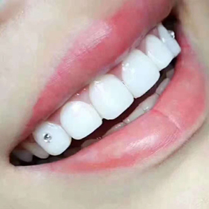 6D纳米浮雕美牙培训让您拥有一口整洁美观的好牙