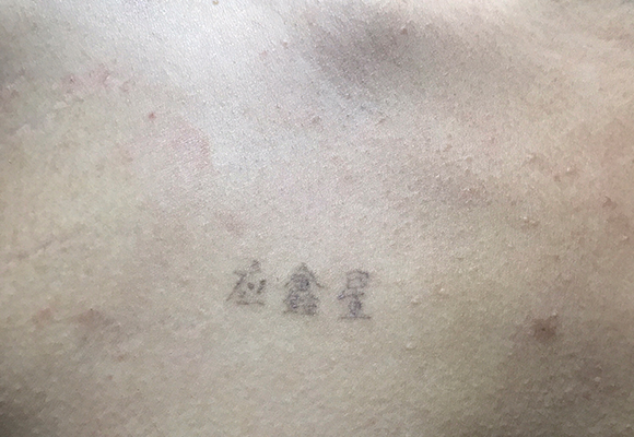 激光洗纹身