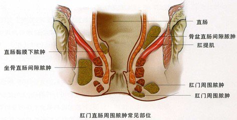 西安肛周脓肿,肛周脓肿的危害,周脓肿的价格,肛周脓肿的治疗措施