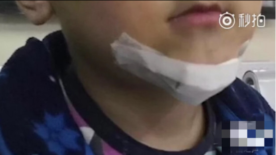 8岁男童模仿抖音弄伤弟弟_郑州市非标零配件加工
