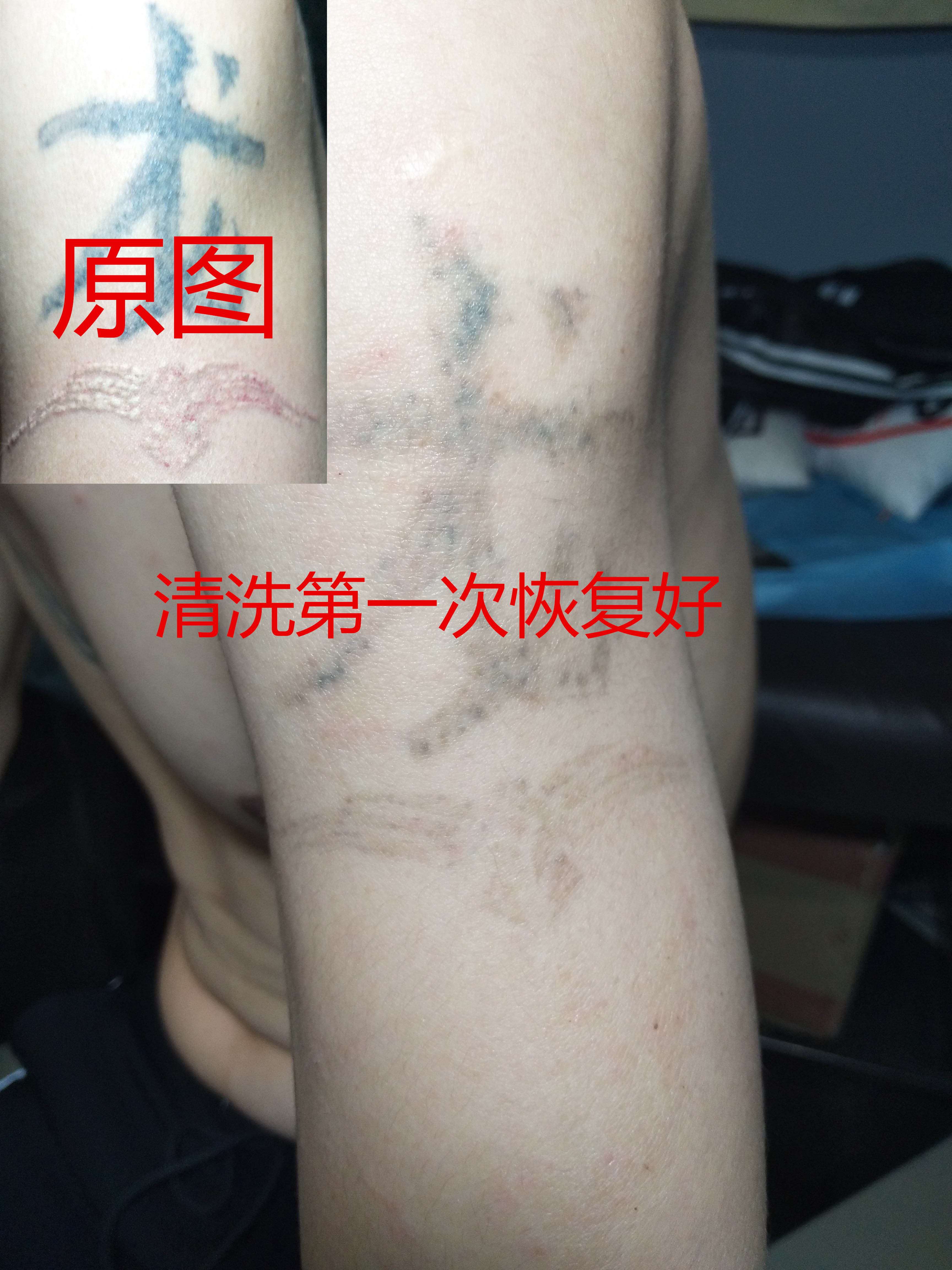你还在担心纹身洗不掉吗？来西安国花刺纹身馆告诉你！