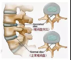 安阳滑县颈椎病中医院告诉你腰间盘突出不是病