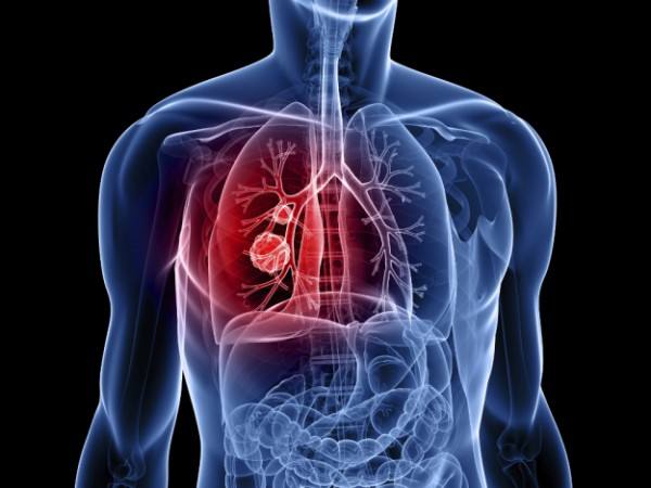 四种美食，中医治疗肺癌专家建议癌症患者多多食用