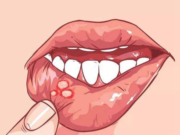 口腔潰瘍的幾種親測體驗