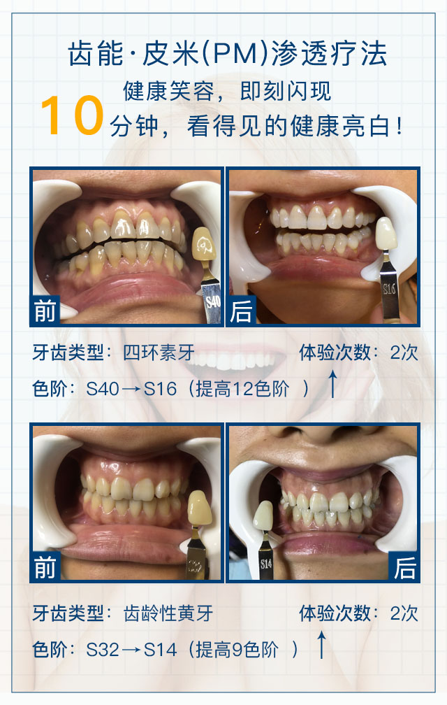 江苏3m拉瓦全瓷牙优点是什么欧蔓尼口腔管理