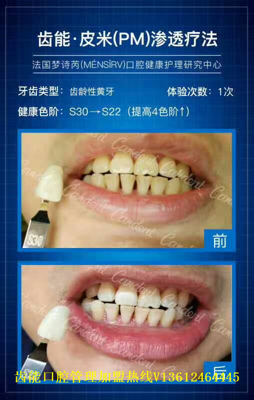 广州牙齿皮米釉质技术在哪里培训