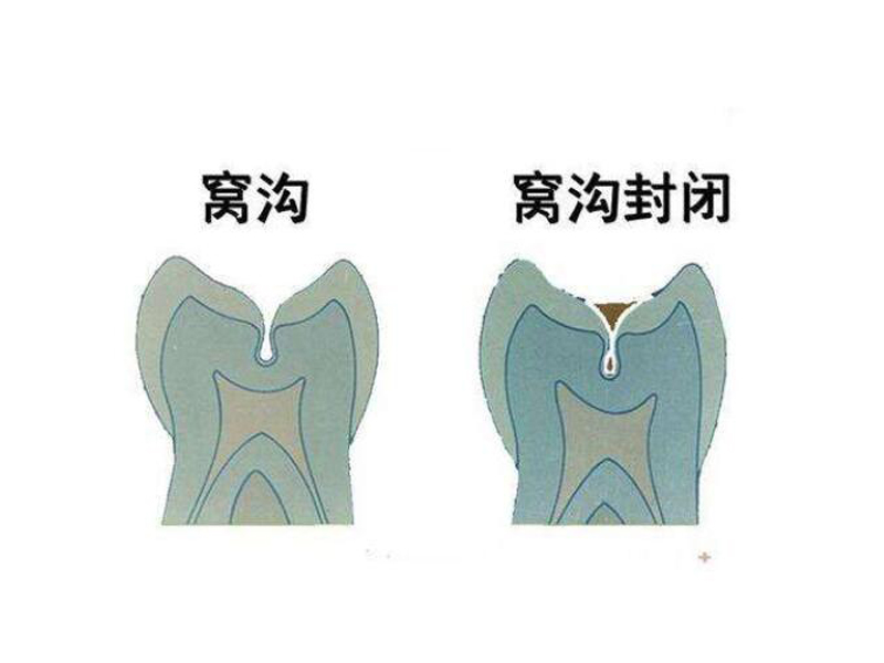 儿童窝沟封闭多少钱