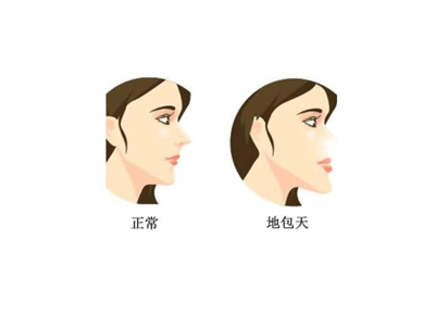 地包天矫正