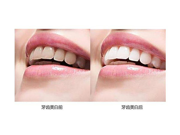 氟斑牙美白