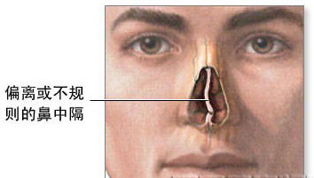 医药 保养 中药饮片 正文 系鼻中隔血肿细菌感染