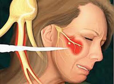 怎么才能有效的减少三叉神经痛，三叉神经牙疼怎么办？