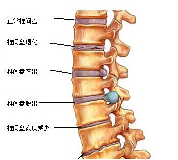 西安灞桥薛氏骨科医院2015年新推出腰椎间盘突出治疗方案