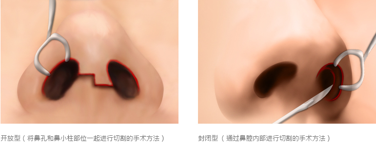 沈阳综合鼻整形医疗机构为您讲解：鼻整形注意事项