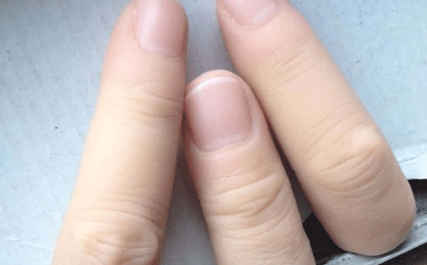 南阳手指假肢怎样正确穿戴？手指假肢穿戴注意事项？