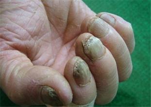 洛阳治疗灰指甲专科医院专家为您解答洛阳治疗灰指甲比较好的方法。