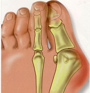 洛阳王城医院治疗大脚骨专家阐述大脚骨术后如何进行康复治疗