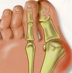 洛阳王城医院治疗大脚骨专科解析大脚骨对人体的影响