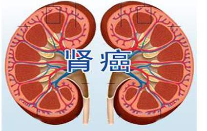 renal cancer