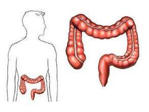 colorectal cancer