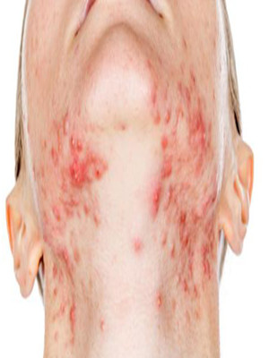 瞧一瞧乌鲁木齐祛粉刺中心为什么说别让痘印坑害你的皮肤