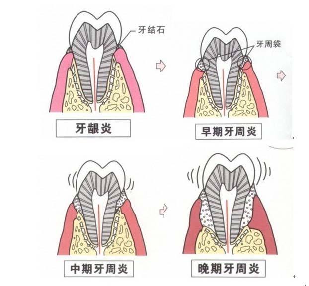 兴安盟誉达口腔医院:牙周炎的发病和预防