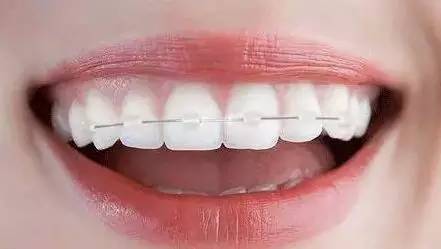 初戴牙套有哪些注意事项 乌兰浩特誉达口腔医院送给准备矫正的你