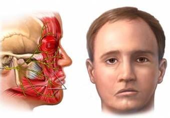 新疆一建医院给您分析面神经麻痹是怎么引起的