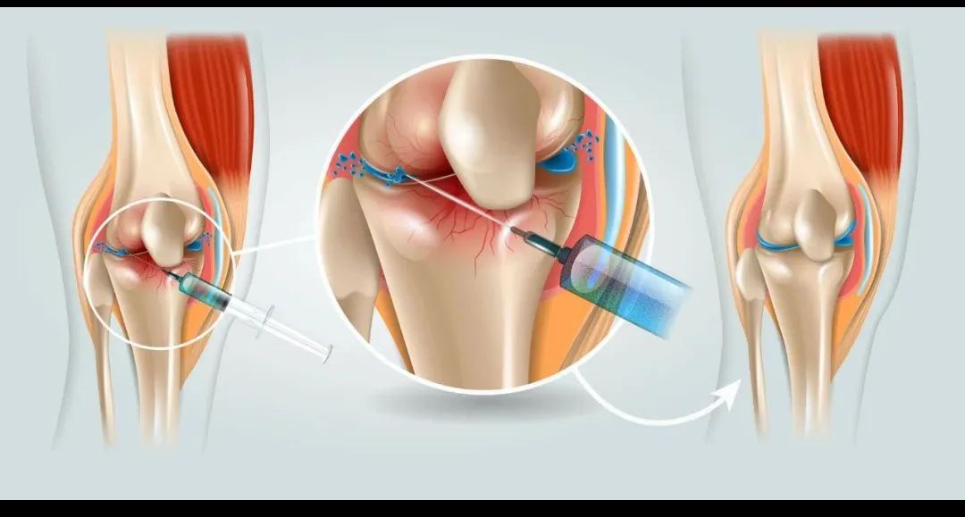 新技术新膝望，PRP治疗——早期膝关病患者的福音